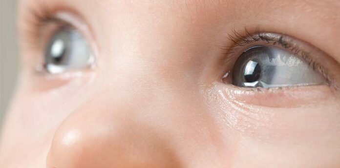 øjne på baby med medfødt grå stær
