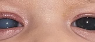 Grøn stær: Gode udsigter med tidlig diagnose Nærbillede af to børneøjne med grøn stær